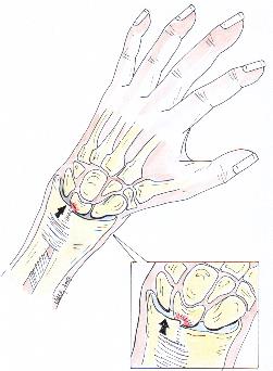 ulnar impaction syndrome